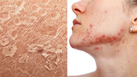Scaling Skin Pictures Causes Treatment And Prevention Kulturaupice