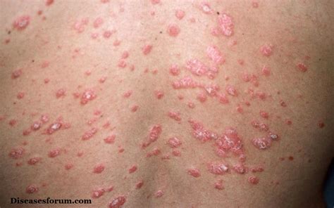 Guttate Psoriasis Symptoms Causes Treatment Pictures Home