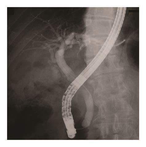Endoscopic Retrograde Cholangiography Images Cholangiogram Revealed No