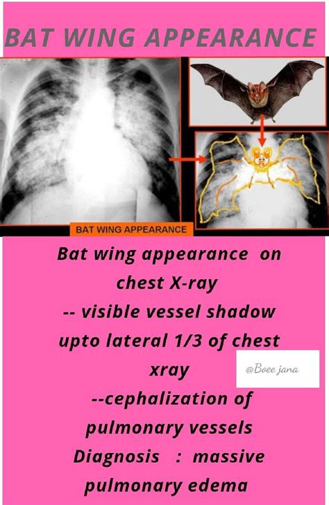 Bat Wing Appearance Medical Surgical Nursing Respiratory Therapy
