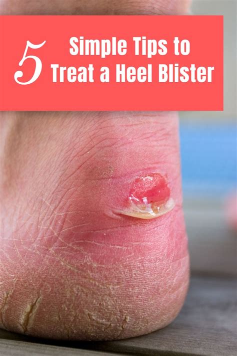 How To Treat A Deep Heel Blister 4 Steps Train For A Heel
