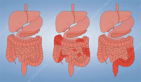 Crohns Disease And Ulcerative Colitis Comparison Stock Image C036