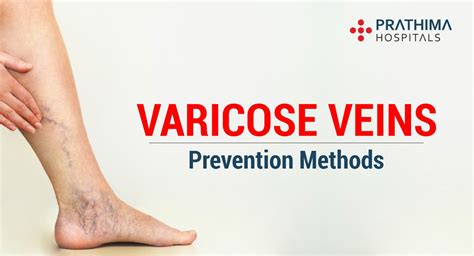 Know About Varicose Veins And Its Prevention Methods