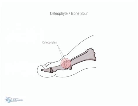 Bone spurs are smooth, bony lumps that grow off bones (like heels, heel spurs) often near joints. Stiff Big Toe (Hallux Rigidus) | Orthopaedic - James Stanley