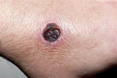 Spider Bite Wound Stock Image C0194223 Science Photo Library