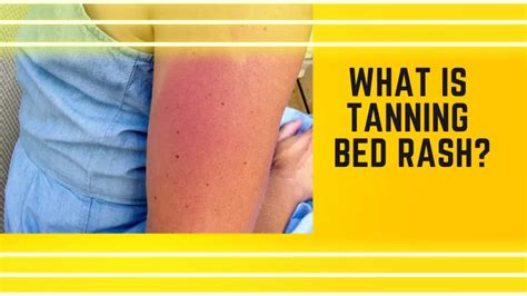 Tanning Bed Rash Causes And Get Rid Of Fast