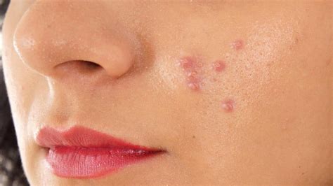 Pimples On Cheeks Small Painful Causes How To Get Rid Lightskincure