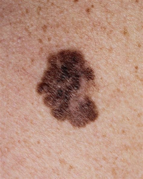 What Is Skin Cancer Bunbury Skin Cancer Clinic