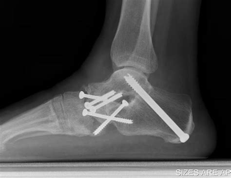 Advances In Ankle Fusion Surgery Effect Of Bone Morphogenetic Protein