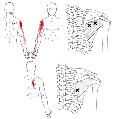 Infraspinatus The Trigger Point And Referred Pain Guide