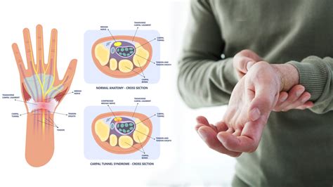 6 Wrist Exercises To Relieve Carpal Tunnel Pain