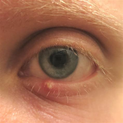 Stye Hordeolum And Chalazion Treatment In Nyc Jimmy Hu