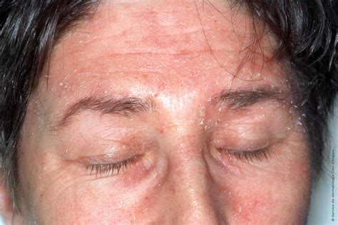 Eczema Versus Seborrheic Dermatitis Eczema Foundation