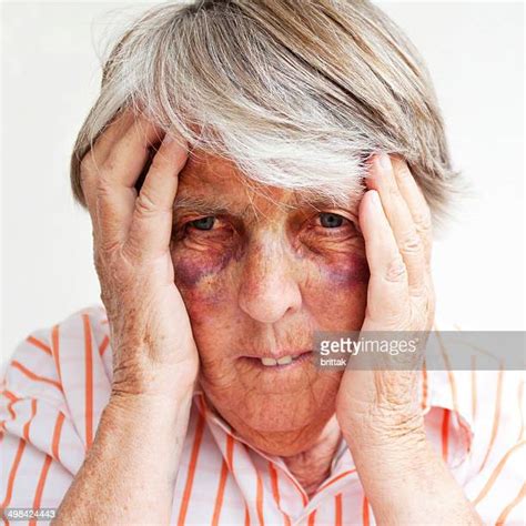 Elderly Woman Bruised Photos And Premium High Res Pictures Getty Images