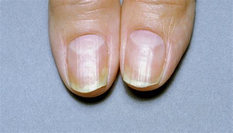 What Vitamin Deficiency Causes White Spots On Your Nails Bios Pics