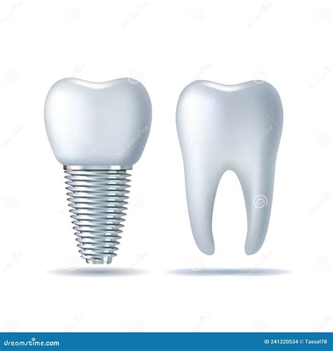 Vector 3d Diente Blanco Realista E Implante Dental Icono De Dentadura