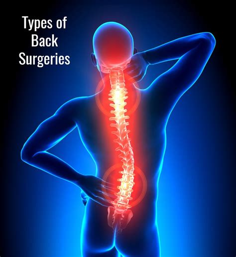 Types Of Back Surgeries