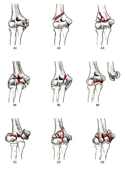 Distal Humerus Fracture Surgery