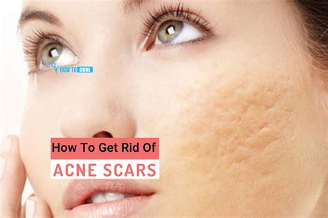 5 Quick Ways For How To Get Rid Of Acne Scars Naturally How To Cure