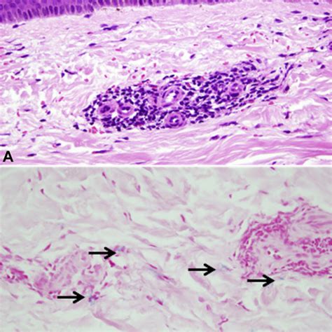 Erythematous Scaly Plaques Scattered On The Face A And B Neck And