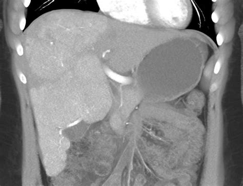 Unusual Appearance Of Focal Nodular Hyperplasia Fnh Liver Case