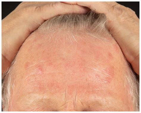 Edematous And Erythematous Papules And Plaques On The Forehead