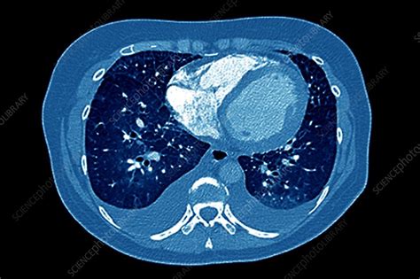 Pleural Effusion Of The Lungs Ct Scan Stock Image C0030936