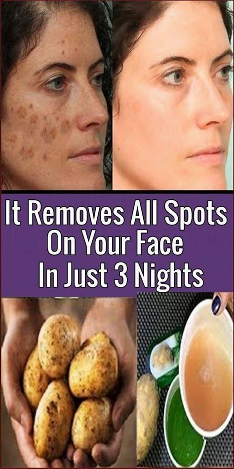 Simple Trick To Remove Brown Spots From Your Skin Brown Patches On Skin
