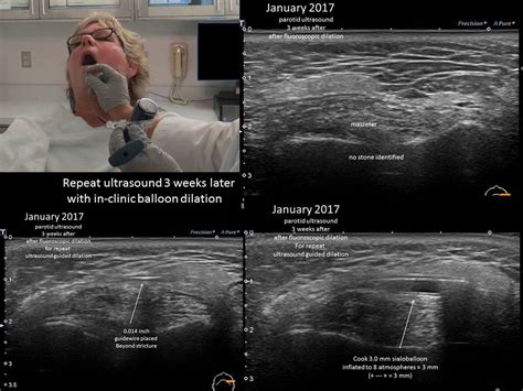 Parotid Gland Duct Ultrasound