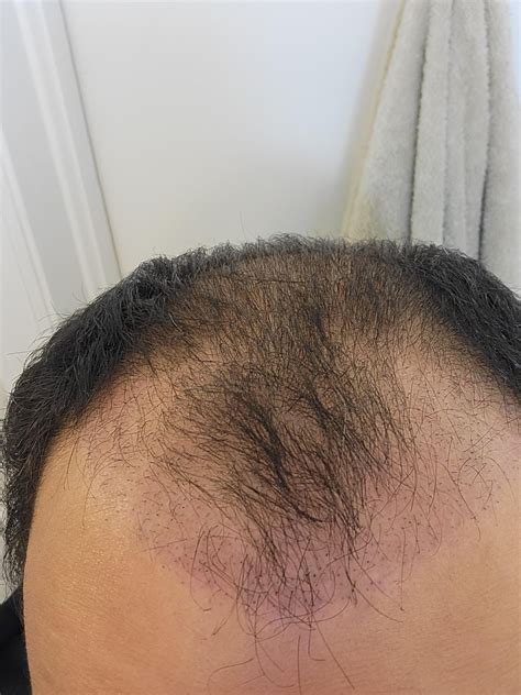 2 Month Update Ugly Duckling Phase Rhairtransplants