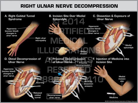 Right Ulnar Nerve Transposition Surgery