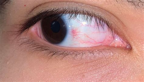 Why Do I Have A Red Spot On My Eye Yoors