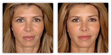 Facial Exercise Before And After Facial Exercise Central