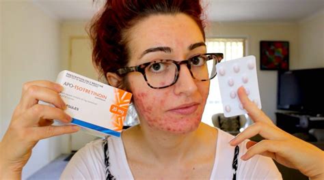 Banish Acne Scars Mask Review 2018 Plus Discount Code Jess Bunty