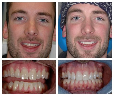 Surrey Lingual Braces Treatments For Rotated Teeth
