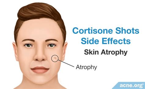 Cortisone Shots For Severe Acne Nodules And Cysts