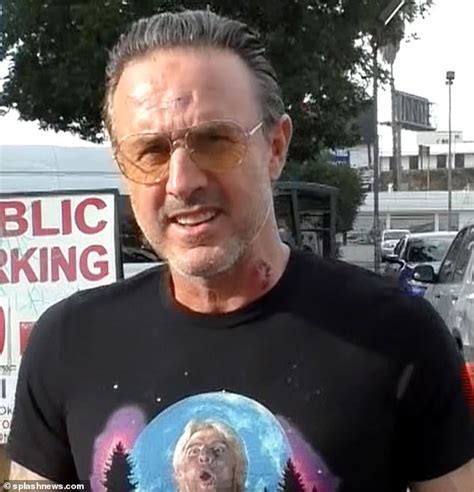David Arquette Sports Gashes And Bruises After Being Brutalized During