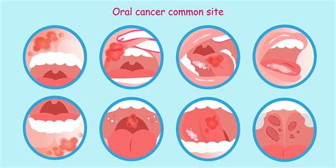 What Are The Risk Factors Of Oral Cancer Your Renton Wa General