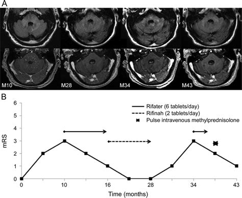 Differential diagnosis, clinical and mri characteristics of clippers syndrome as well as treatment approaches are discussed. Effective antituberculous therapy in a patient with ...