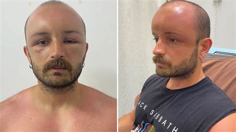 Man Develops Swollen Head After Spending Day At Beach Doctors Socked
