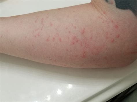 Hives On My Arm Allergy Preventions