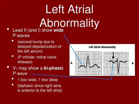 Ppt Atrial And Ventricular Enlargement Powerpoint Presentation Free