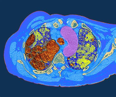 Lung Fibrosis Ct Scan Photograph By Du Cane Medical Imaging Ltd Pixels