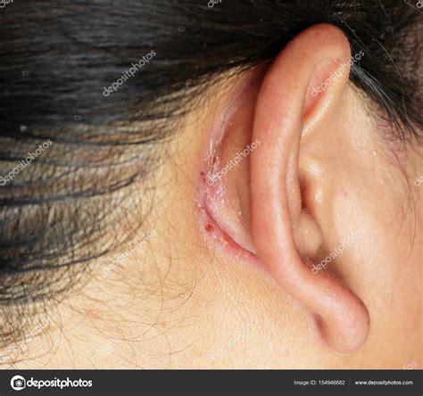 Wound Behind Ear — Stock Photo © Gap 154946682
