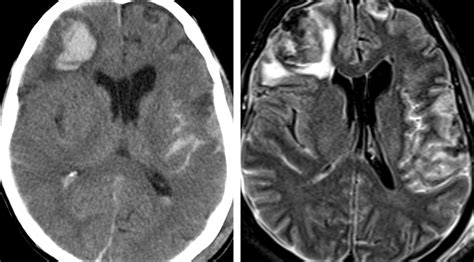 Traumatic Subarachnoid Hemorrhage Tsah The Neurosurgical Atlas