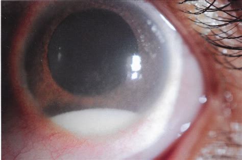 Retinoblastoma For The Retina Specialist Retina Round Up