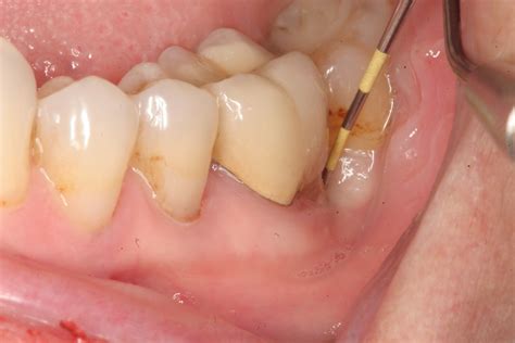 Abscessed Teeth Perio Peak