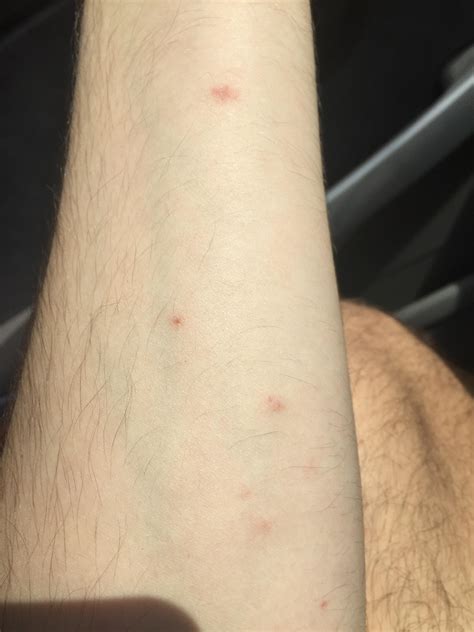 What Are These Red Spots Appearing All Over My Body They Arent Itchy