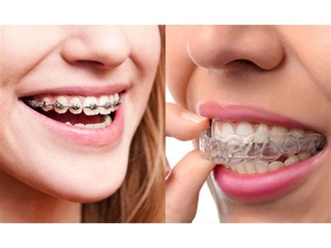 Braces Vs Invisalign Which Teeth Straightening Mechanism Is Best For