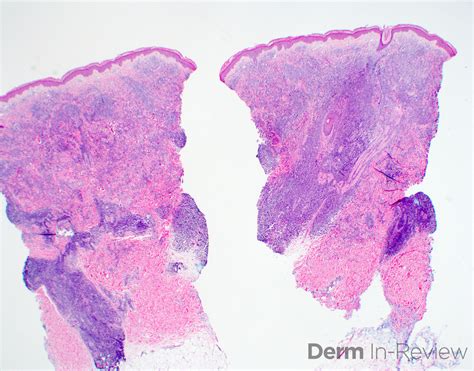 Figure 5189a Derm In Review